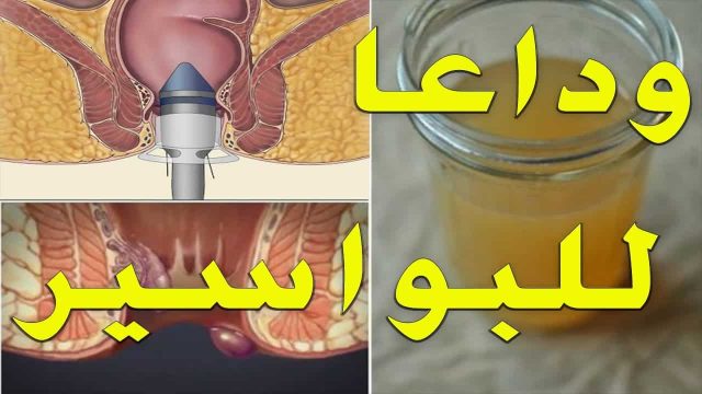 ادوية البواسير الداخلية | موسوعة الشرق الأوسط