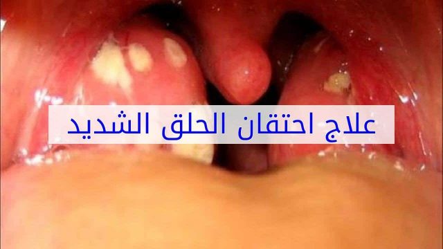 ادوية علاج احتقان الزور | موسوعة الشرق الأوسط