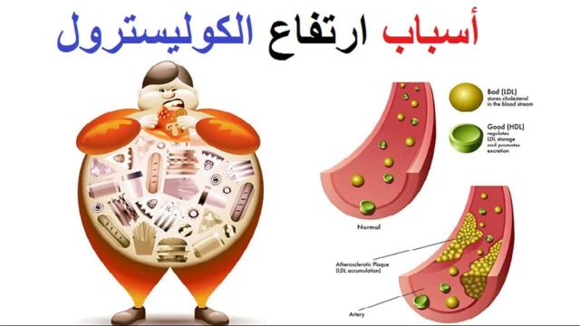 ارتفاع الكولسترول في الدم | موسوعة الشرق الأوسط