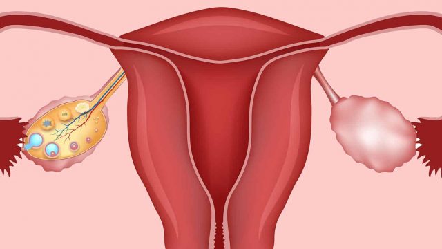 اسباب تكيس المبايض عند المتزوجات | موسوعة الشرق الأوسط