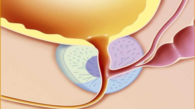 اعراض احتقان البروستاتا المزمن | موسوعة الشرق الأوسط