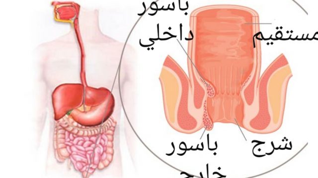 اعراض البواسير الداخلية عند النساء | موسوعة الشرق الأوسط