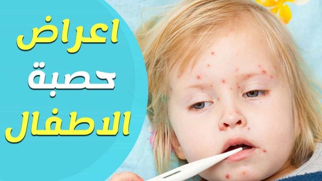 اعراض الحصبة عند الاطفال | موسوعة الشرق الأوسط