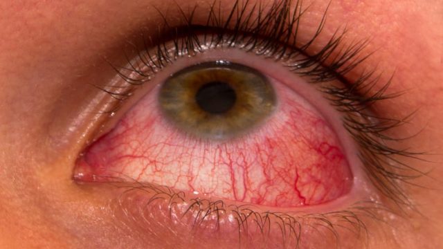 الرمد الربيعى Spring Conjunctivitis | موسوعة الشرق الأوسط