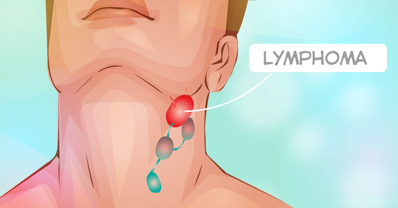 الفرق بين التهاب وسرطان الغدد الليمفاوية2 | موسوعة الشرق الأوسط