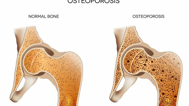 بحث عن مرض هشاشة العظام | موسوعة الشرق الأوسط