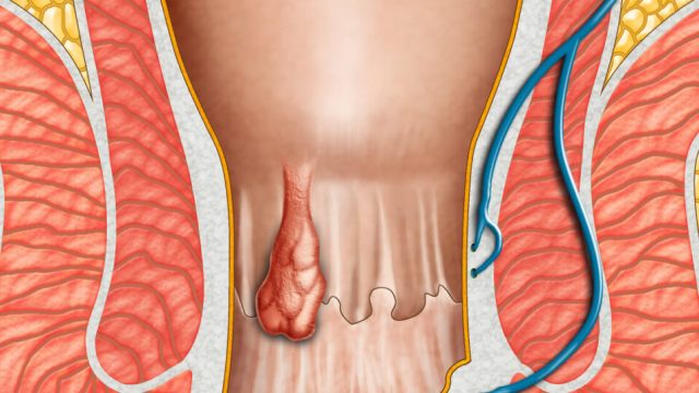 بواسير الداخلية 1024x536 1 | موسوعة الشرق الأوسط
