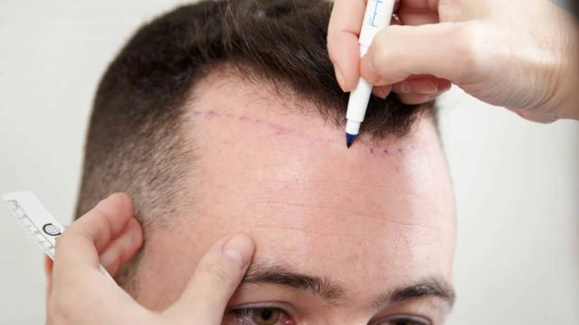 تجربتي لزراعة الشعر في تركيانا | موسوعة الشرق الأوسط