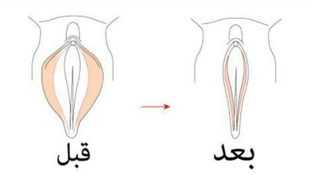 تضييق المهبل 20210621001912 | موسوعة الشرق الأوسط