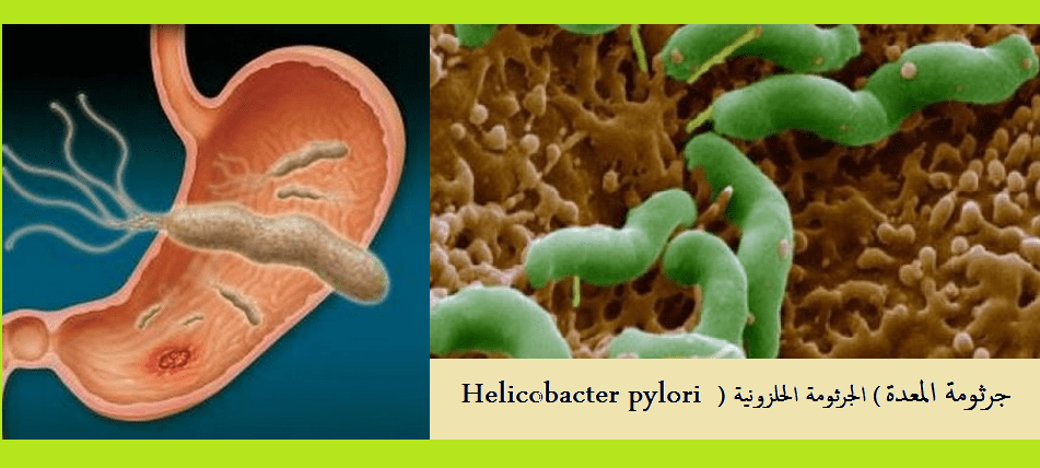 جرثومة المعدة | موسوعة الشرق الأوسط