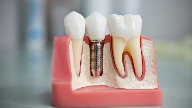 زراعة الأسنان بدون جراحة | موسوعة الشرق الأوسط