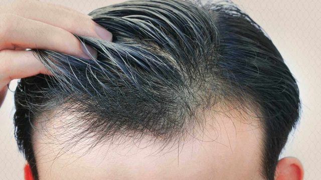 زراعة الشعر في السعودية | موسوعة الشرق الأوسط