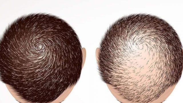 زراعة الشعر في جدة | موسوعة الشرق الأوسط