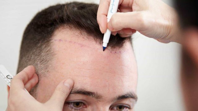 زراعة الشعر في جدة1 | موسوعة الشرق الأوسط