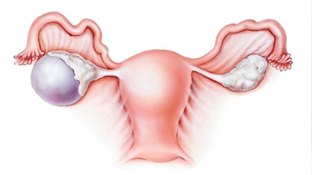 سرطان المبيض والدورة الشهرية | موسوعة الشرق الأوسط