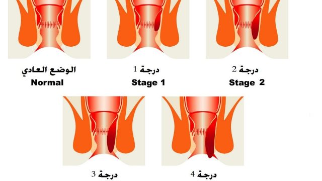 علاج البواسير بالفازلين | موسوعة الشرق الأوسط