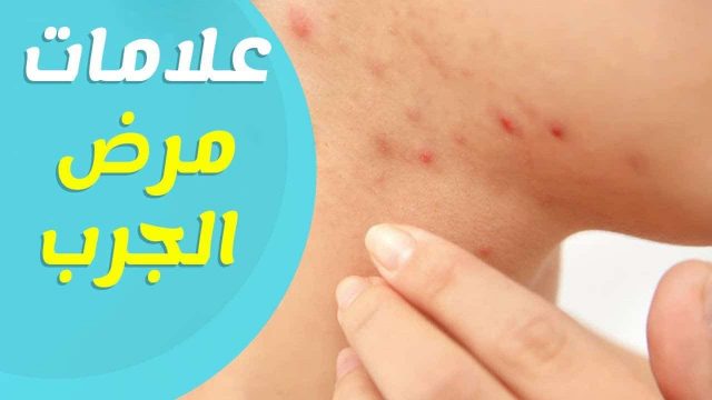 علاج الجرب عند الأطفال | موسوعة الشرق الأوسط