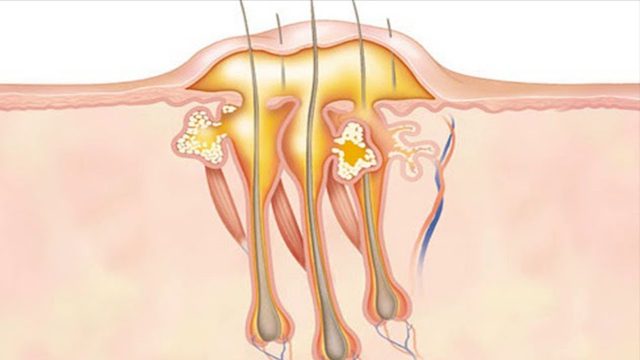 علاج الدمامل في الطب النبوي | موسوعة الشرق الأوسط