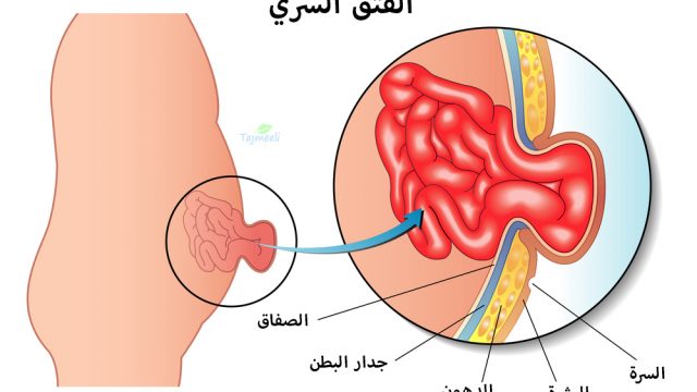 علاج الفتق الأربي بدون جراحة | موسوعة الشرق الأوسط