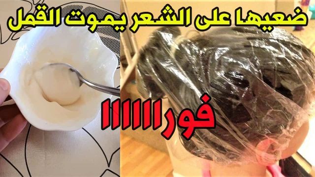 علاج القمل والصيبان من أول مره | موسوعة الشرق الأوسط