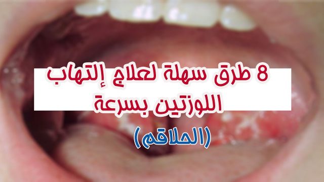 علاج اللوز مجرب | موسوعة الشرق الأوسط