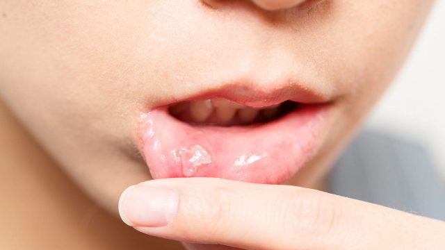 علاج جروح الفم | موسوعة الشرق الأوسط