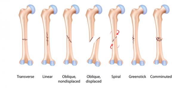 علامات جبر العظام | موسوعة الشرق الأوسط