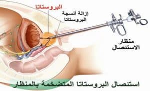 عملية استئصال البروستات | موسوعة الشرق الأوسط