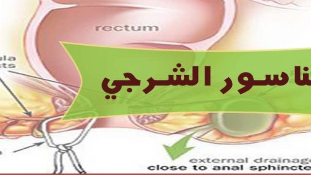 عملية الناسور | موسوعة الشرق الأوسط