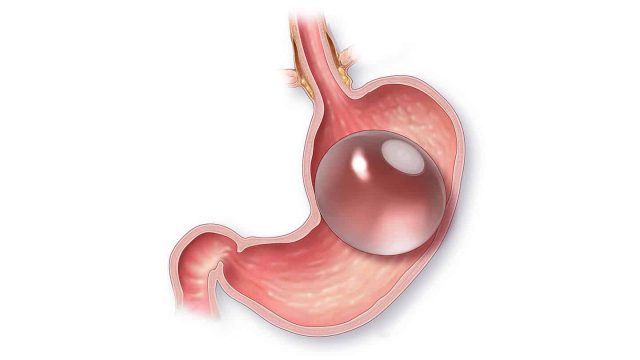 عملية بالون المعدة | موسوعة الشرق الأوسط