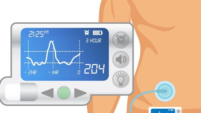 كم سعر مضخة الانسولين في السعودية | موسوعة الشرق الأوسط