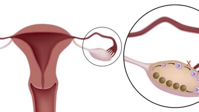 كيس على المبيض | موسوعة الشرق الأوسط