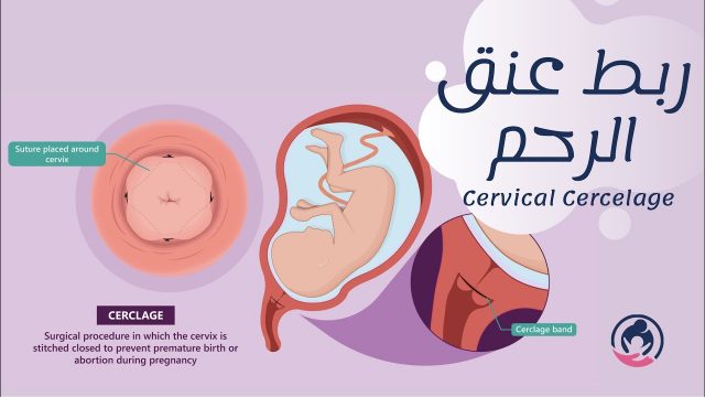 كيف اعرف ان ربط عنق الرحم انفك | موسوعة الشرق الأوسط