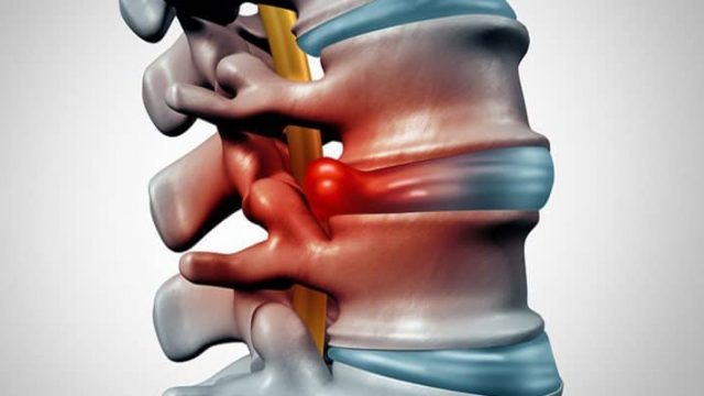 ماهو الطب البديل بالأعشاب لوجع الدسك | موسوعة الشرق الأوسط