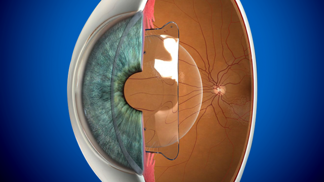 متى تتحسن الرؤية بعد عملية زرع العدسة icl | موسوعة الشرق الأوسط