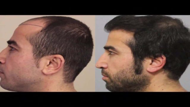 معلومات عن دكتور محمد جوتشلو في زراعة الشعر بتركيا | موسوعة الشرق الأوسط